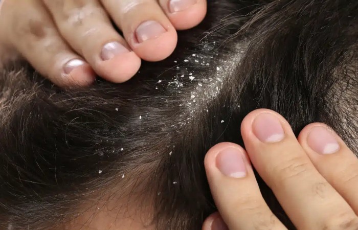 What Causes Dandruff Dandruff Naturally